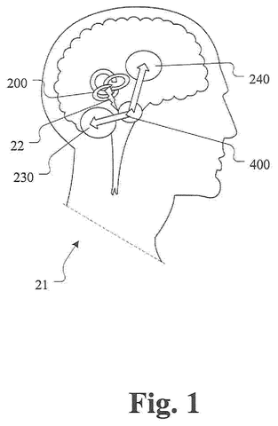 Motion stimulation device in head, drawing sheet 1 from US 2026/0233003 A1