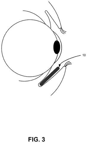 Sensor placement inside lower eyelid, drawing sheet 3 from US 2026/0305985 A1